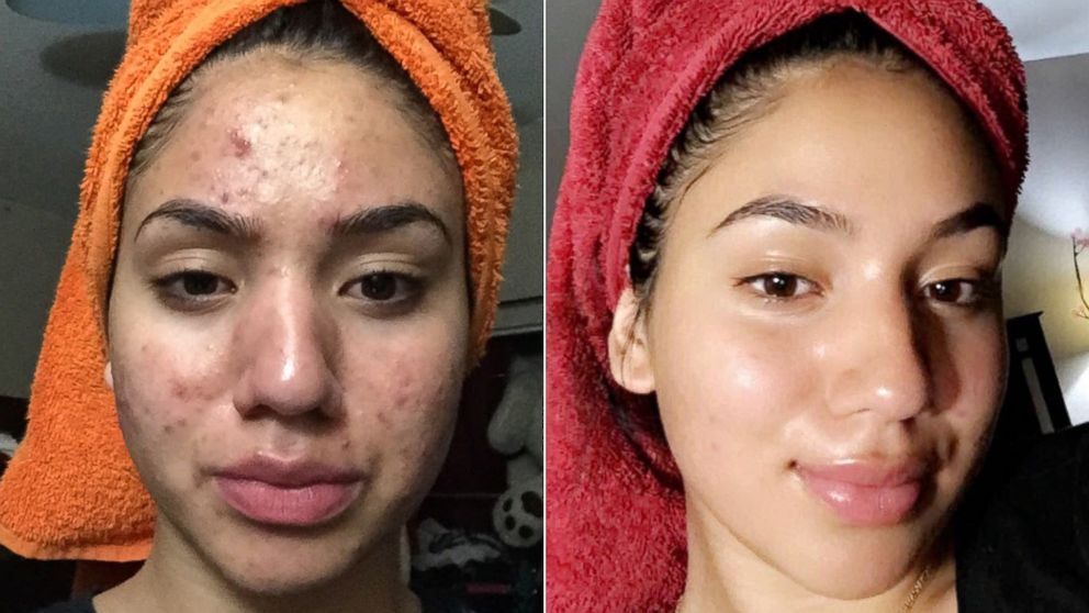 Before and after acne treatment comparison showing dramatic skin improvement