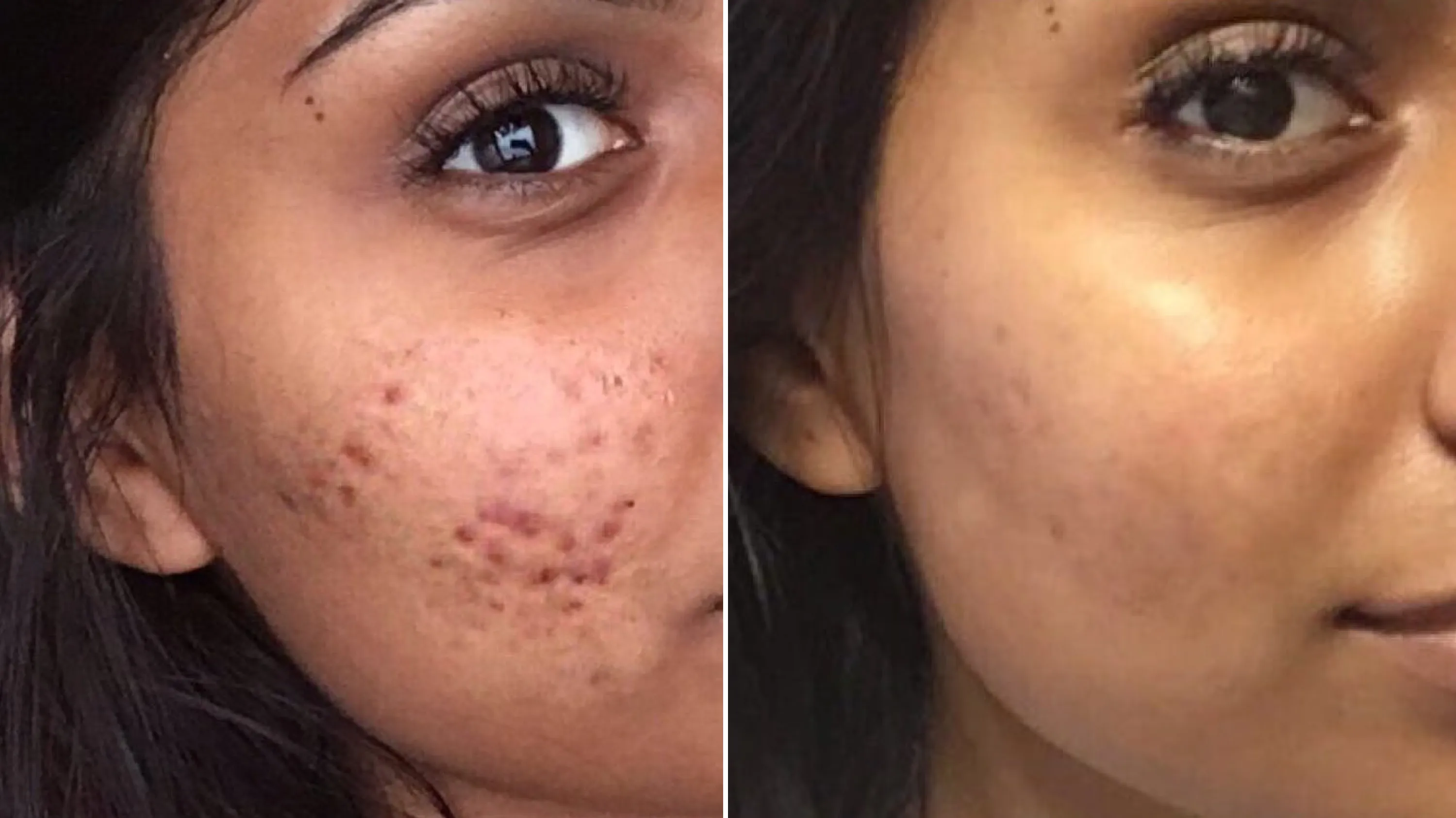 Before and after 8 weeks treatment for Hormonal Acne